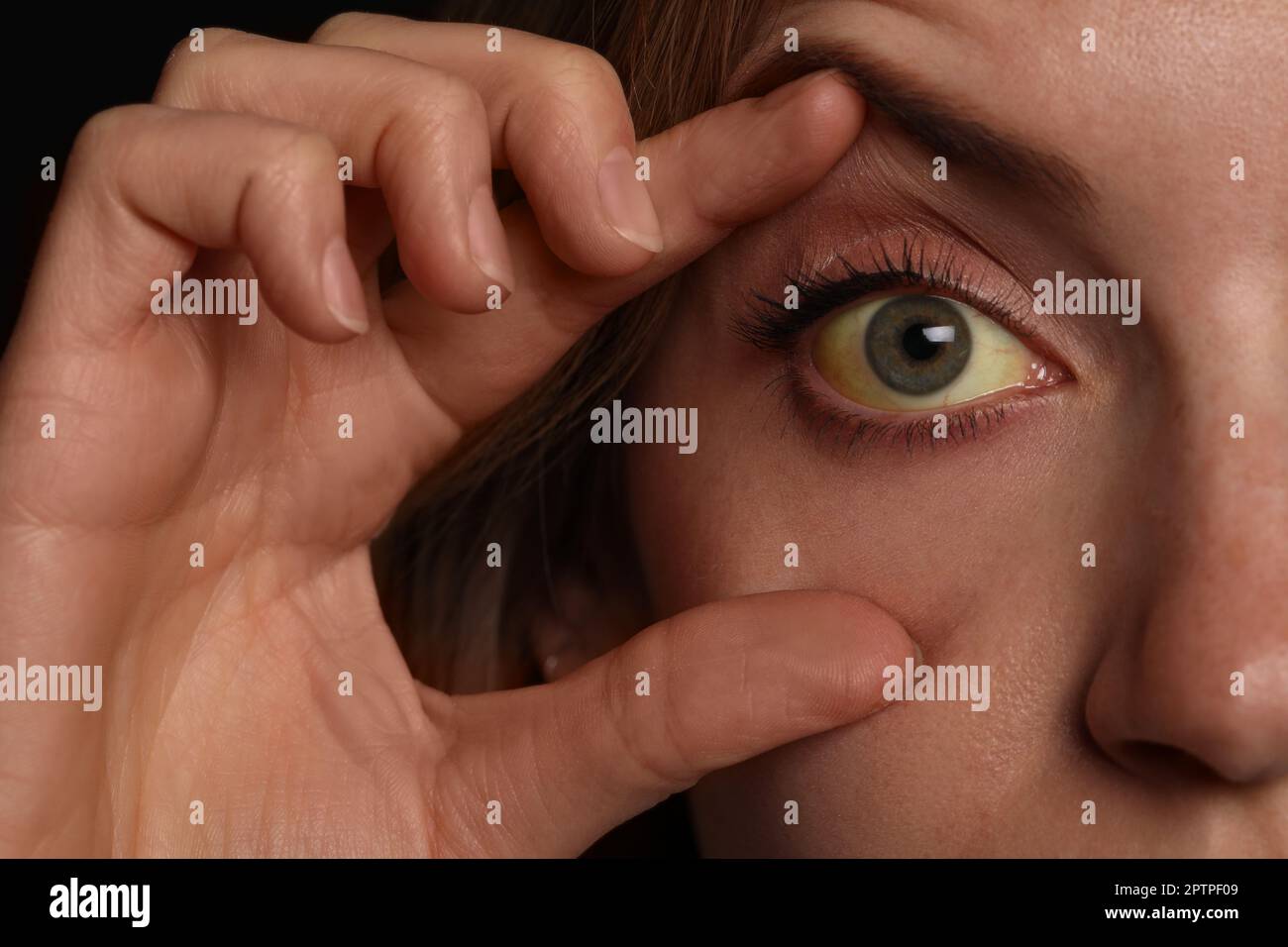 Femme vérifiant son état de santé, gros plan. Yeux jaunes comme symptôme de problèmes avec le foie Banque D'Images