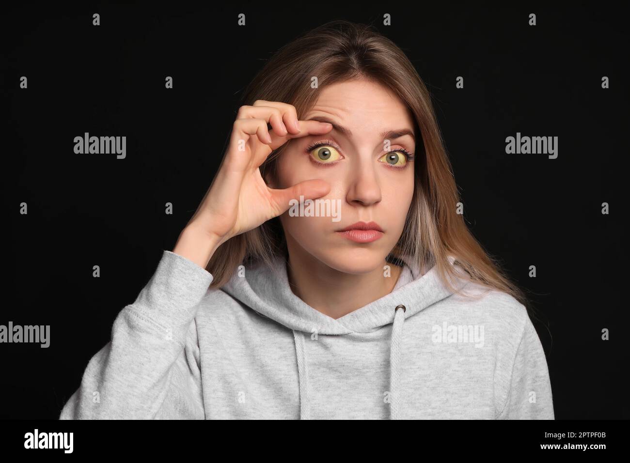 Femme vérifiant son état de santé sur fond noir. Yeux jaunes comme symptôme de problèmes avec le foie Banque D'Images