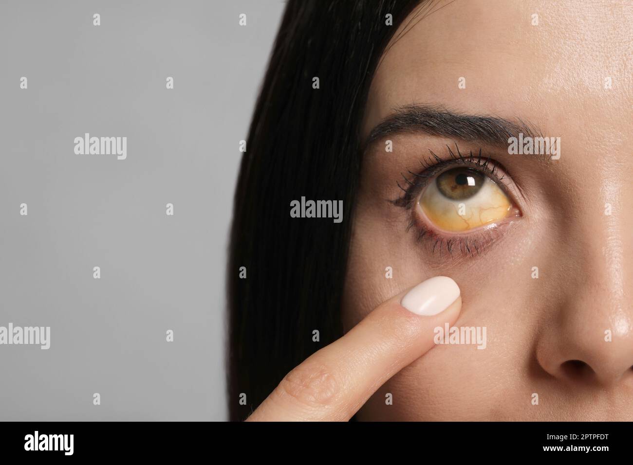 Femme vérifiant son état de santé sur fond gris, gros plan. Yeux jaunes comme symptôme de problèmes avec le foie Banque D'Images