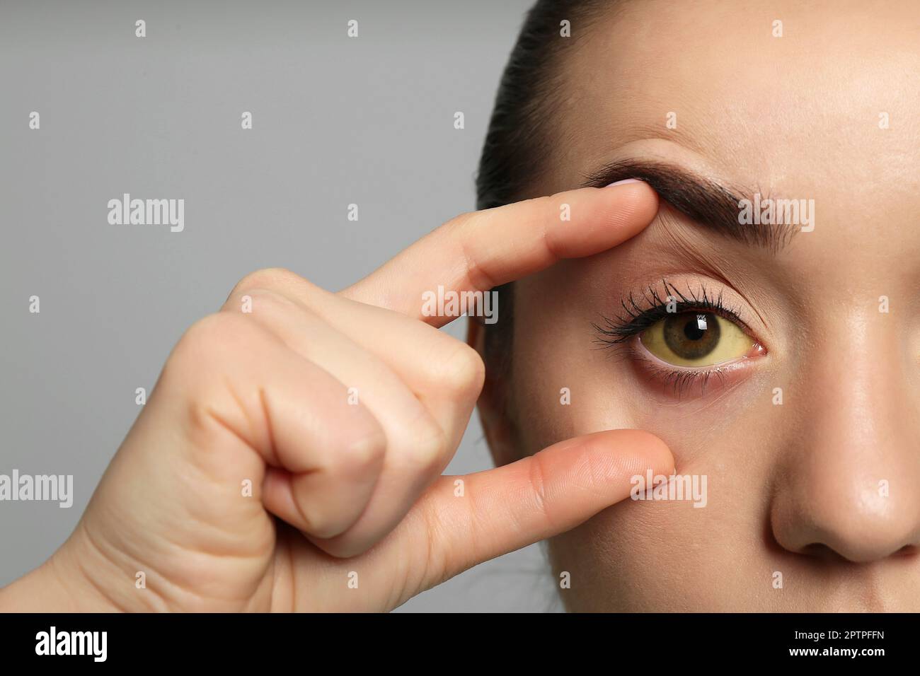 Femme vérifiant son état de santé sur fond gris, gros plan. Yeux jaunes comme symptôme de problèmes avec le foie Banque D'Images