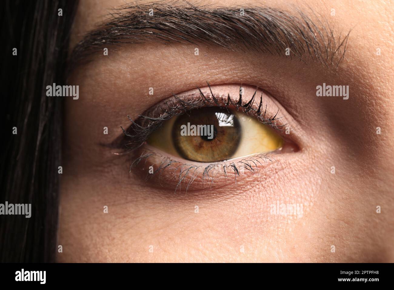 Femme avec les yeux jaunes comme arrière-plan, gros plan. Symptômes des problèmes hépatiques Banque D'Images