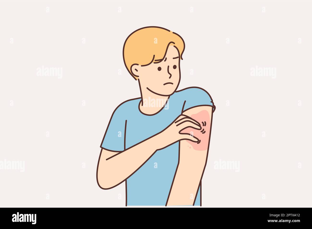 Un homme malsain se grattant le bras souffrent de la varicelle Illustration de Vecteur