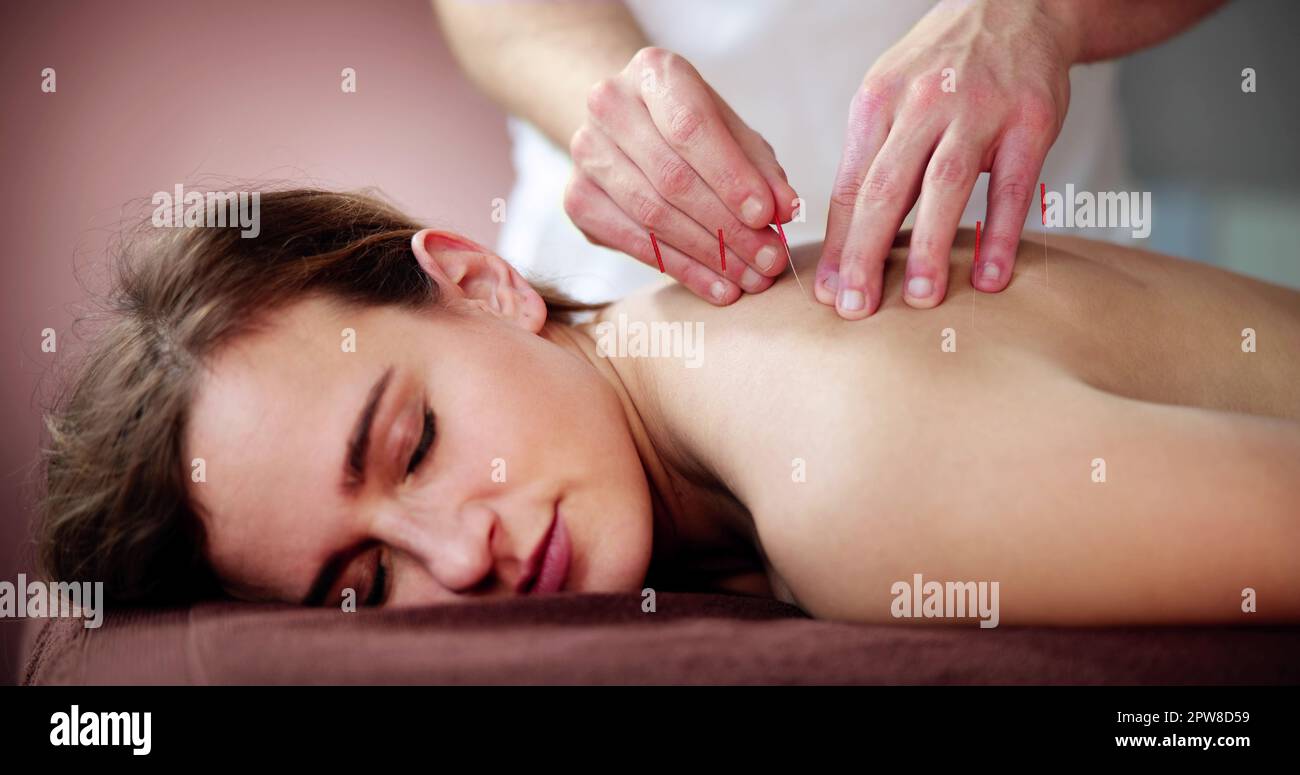 Traitement d'acupuncture à aiguille sèche. Thérapie Spa médicale féminine Banque D'Images