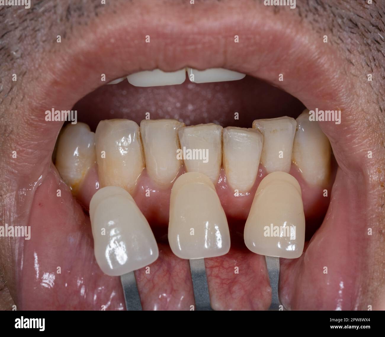 Fermez la bouche. Couleur des dents du médecin assortie à la palette. dentisterie esthétique Banque D'Images