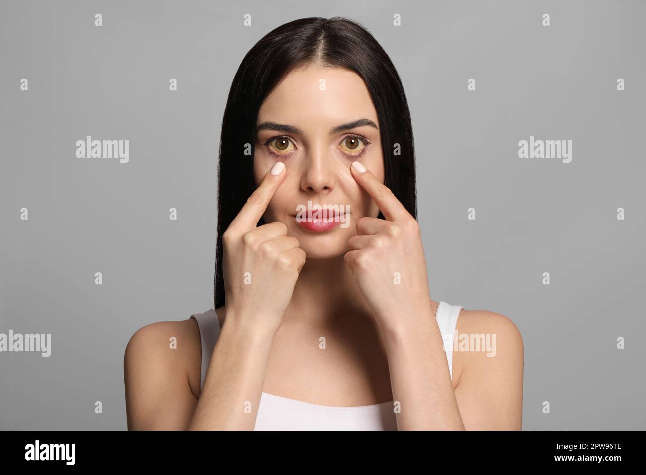 Femme vérifiant son état de santé sur fond gris. Yeux jaunes comme symptôme de problèmes avec le foie Banque D'Images