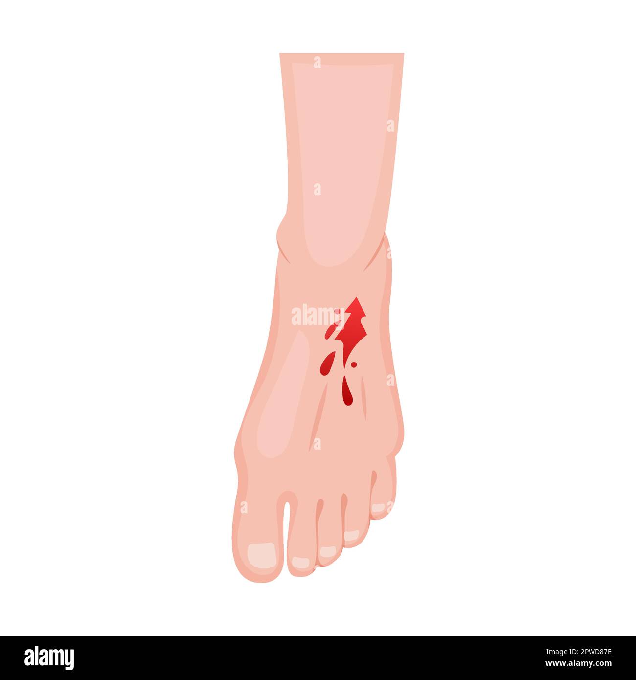 lacération ouverte sur le dessus du pied. Traumatismes de la peau sur la partie du corps. Illustration vectorielle de plaies ouvertes avec saignements, fractures et ecchymoses Illustration de Vecteur