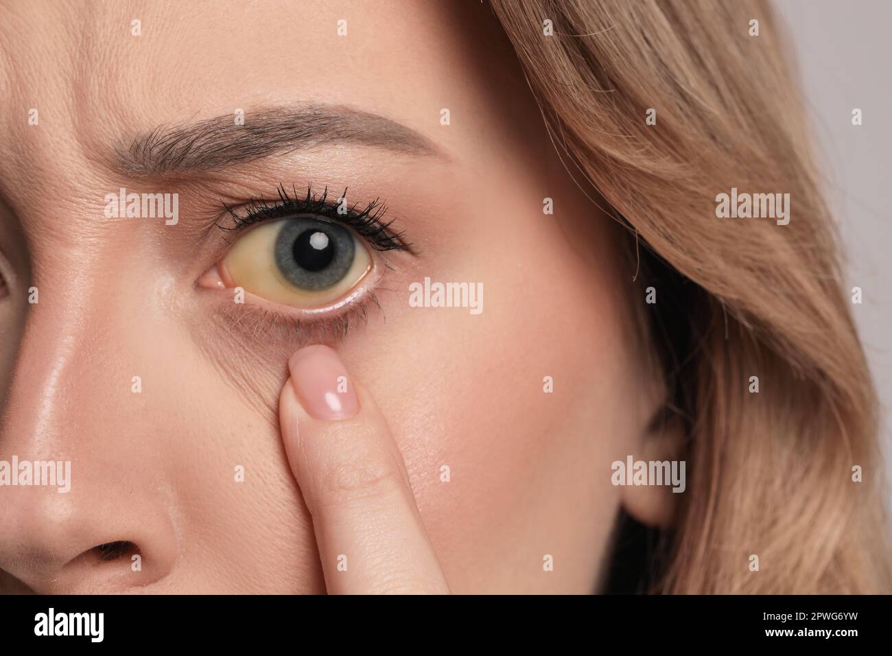 Femme aux yeux jaunes, gros plan. Symptômes des problèmes hépatiques Banque D'Images