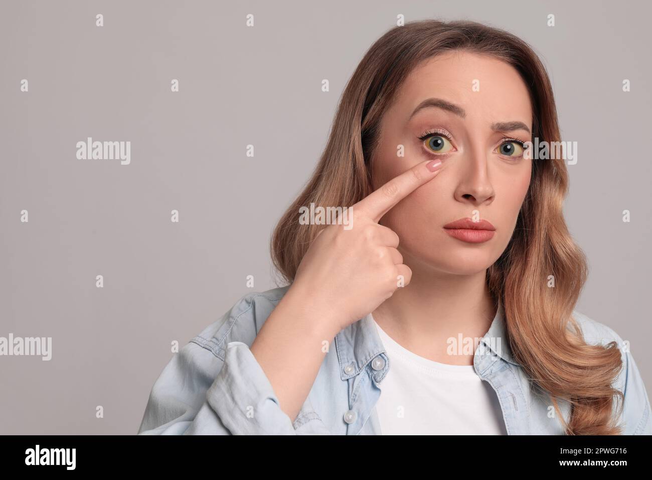 Femme avec des yeux jaunes sur fond gris, espace pour le texte. Symptômes des problèmes hépatiques Banque D'Images
