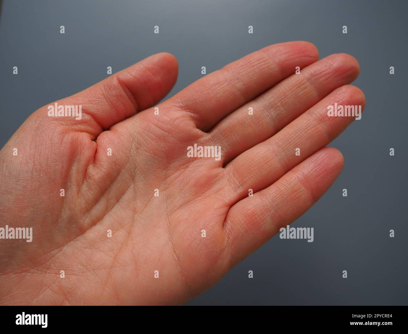 Main féminine avec peau atopique sèche. Fond blanc. Gros plan de la peau sur la paume et les doigts. Problèmes dermatologiques. Dire la fortune par les lignes sur la main, palmistrie Banque D'Images