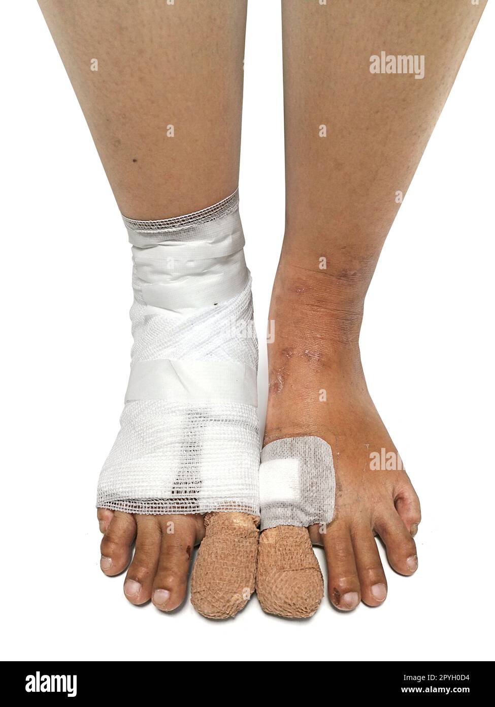 gros plan sur une femme aux orteils récemment opérée avec des bandages Banque D'Images