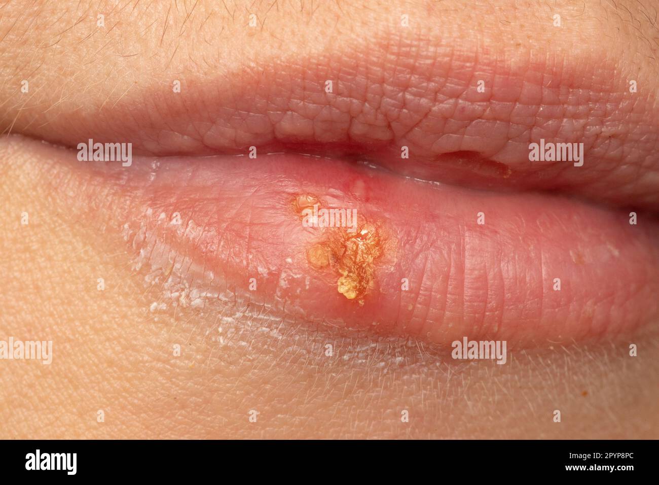 Macro des lèvres de la femme avec des plaies froides. Les pustules de l'herpès simplex se rapprochent dans la bouche d'une femme. Banque D'Images