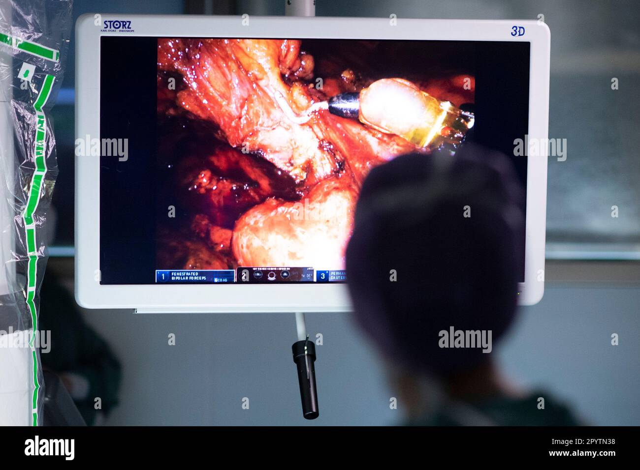 Le médecin assiste au cours d'une chirurgie hybride moderne, 3D technologie innovante avec le système DaVinci une robotique KI de chirurgie assistée par robot. Opération d'une tumeur sur le foie et l'estomac à l'hôpital universitaire Carl Gustav Carus, clinique et polyclinique pour la chirurgie viscérale, la chirurgie thoracique et vasculaire et Centre pour les maladies tumorales à Dresde, Saxe, Allemagne. La chirurgie assistée par robot est une procédure chirurgicale moderne en médecine. Il permet au chirurgien de réaliser des techniques chirurgicales peu invasives avec le soutien du système assisté par robot Banque D'Images