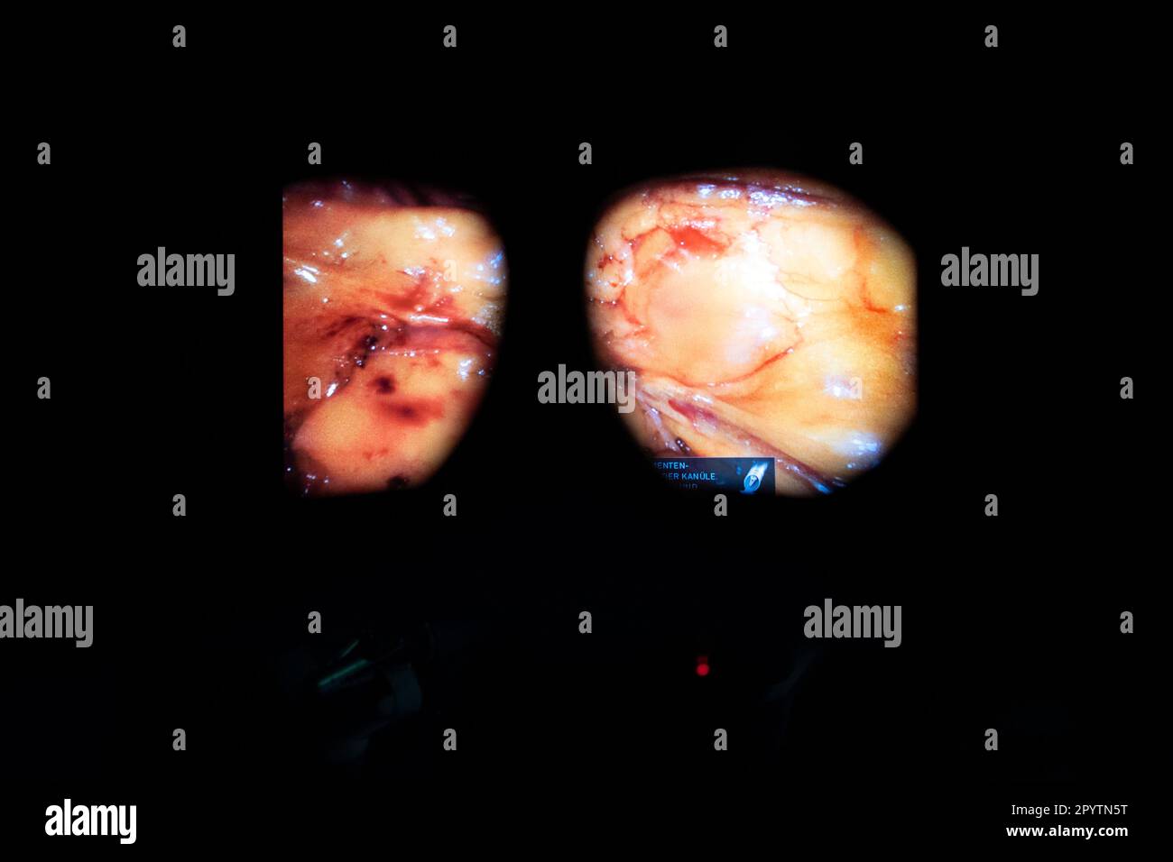 Chirurgie hybride moderne, 3D technologie innovante avec le système DaVinci une robotique KI de chirurgie assistée par robot. Opération d'une tumeur sur le foie et l'estomac à l'hôpital universitaire Carl Gustav Carus, clinique et polyclinique pour la chirurgie viscérale, la chirurgie thoracique et vasculaire et Centre pour les maladies tumorales à Dresde, Saxe, Allemagne. La chirurgie assistée par robot est une procédure chirurgicale moderne en médecine. Il permet au chirurgien de réaliser des techniques chirurgicales peu invasives avec le soutien du système assisté par robot Banque D'Images