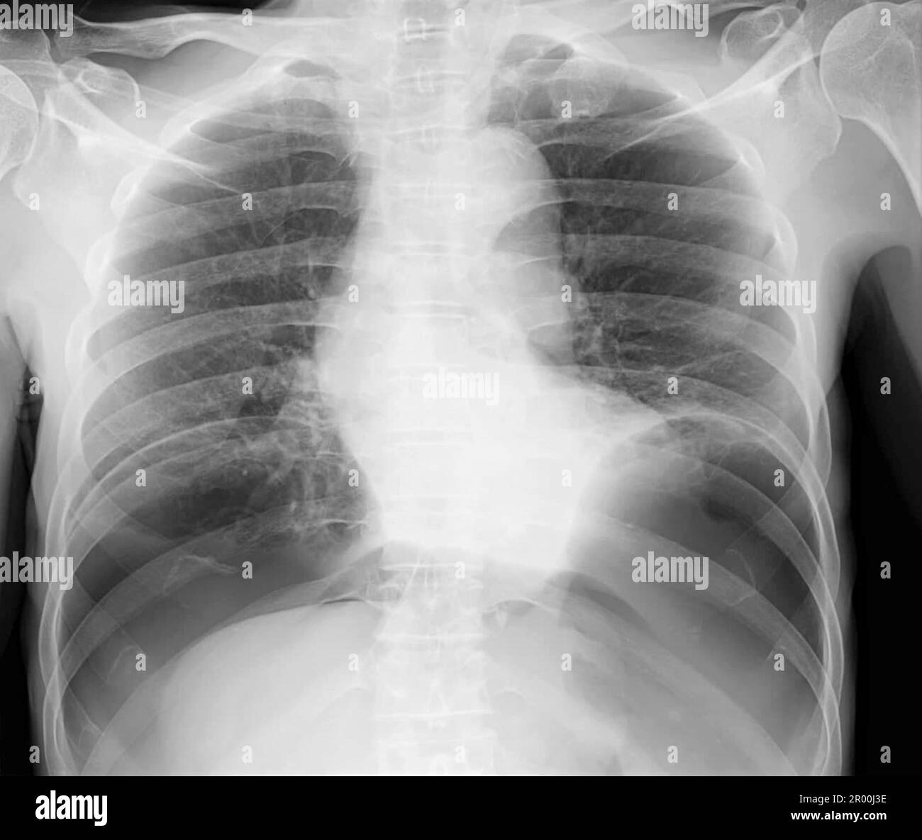 Pneumopéritoine, rayons X. Banque D'Images