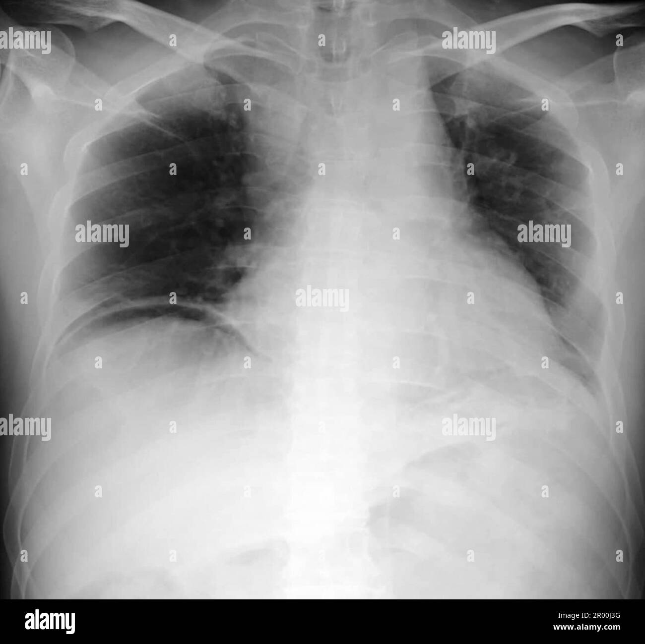 Pneumopéritoine, rayons X. Banque D'Images