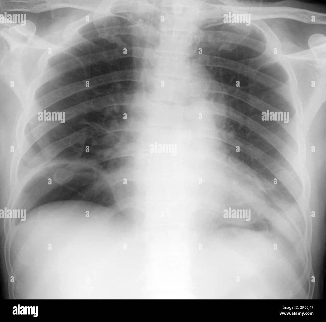 Pneumopéritoine, rayons X. Banque D'Images