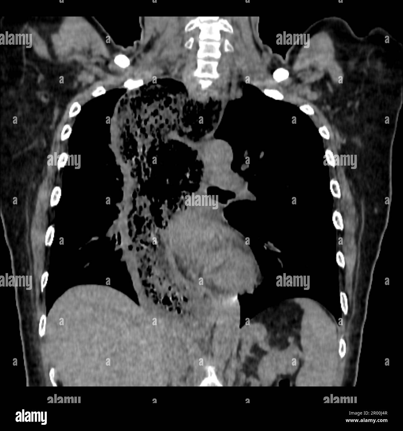 Achalasie de l'œsophage, acquisition CT Banque D'Images