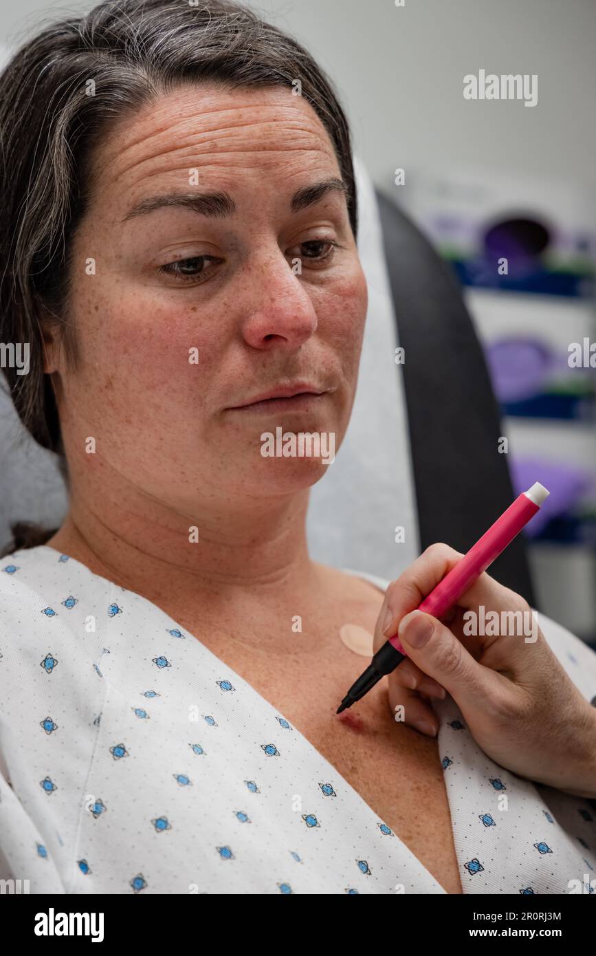 Dermatologue sur le point de tracer la ligne sur la jeune femme 30s pour la procédure d'excision de carcinome basocellulaire en clinique. Banque D'Images