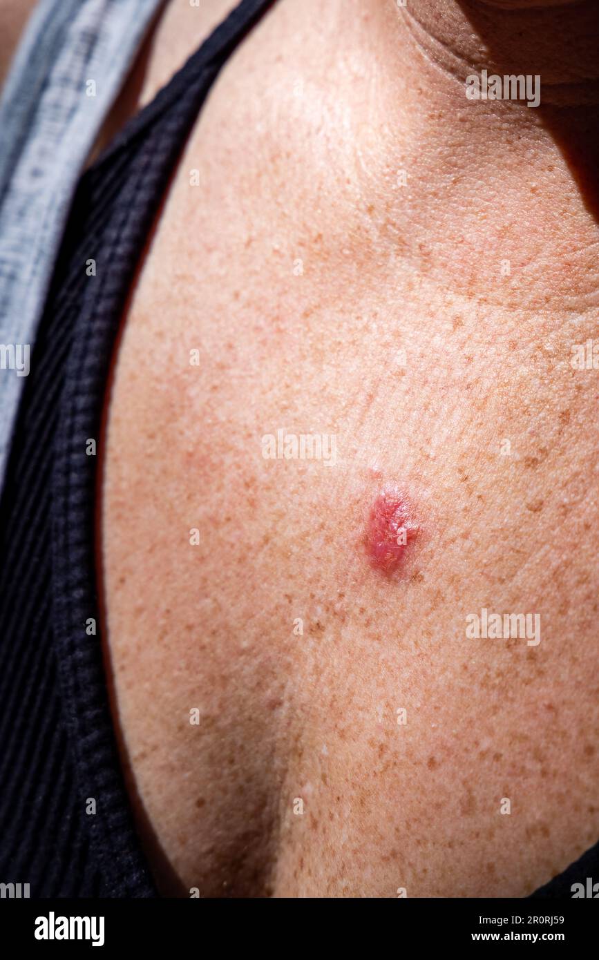 Jeune femme 30s gros plan de la poitrine avant d'appliquer le médicament de crème imiquimod au carcinome basocellulaire. Banque D'Images