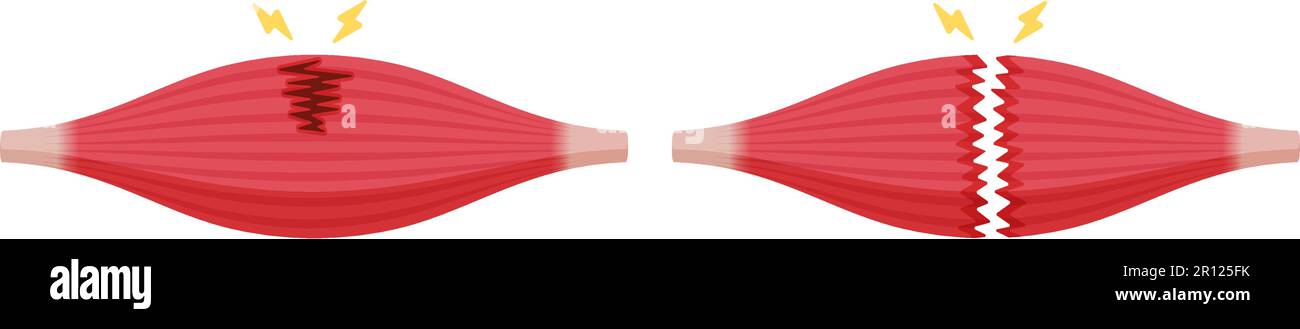 Illustration du vecteur de rupture musculaire (déchirures partielles et complètes ) Illustration de Vecteur