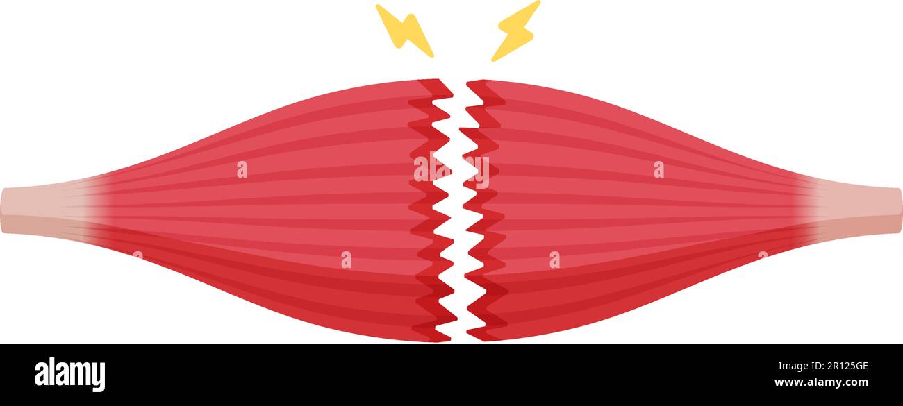 Illustration du vecteur de rupture musculaire ( déchirure complète ) Illustration de Vecteur Illustration du vecteur de rupture musculaire ( déchirure complète ) Illustration de Vecteur