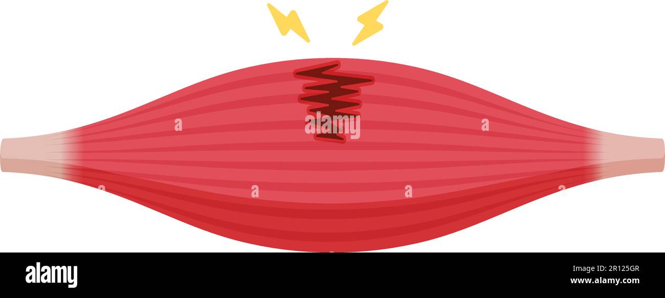 Illustration du vecteur de rupture musculaire (déchirure partielle ) Illustration de Vecteur