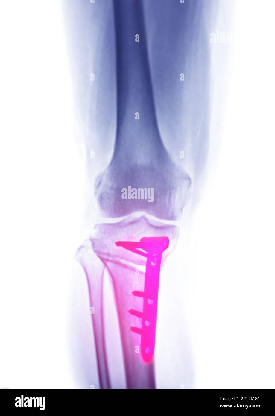 Image radiographique de la vue AP du genou droit montrant l'arthroplastie totale du genou et les fractures du plateau tibial avec fixation de la plaque et de la vis. Banque D'Images Image radiographique de la vue AP du genou droit montrant l'arthroplastie totale du genou et les fractures du plateau tibial avec fixation de la plaque et de la vis. Banque D'Images