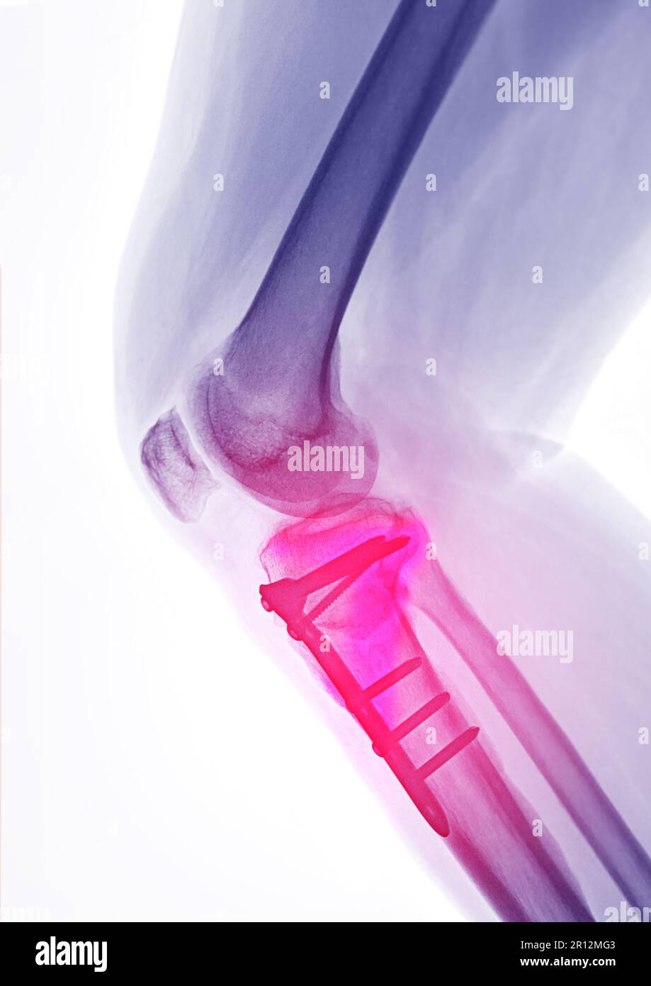 Image radiographique du genou droit vue latérale montrant l'arthroplastie totale du genou et les fractures du plateau tibial avec fixation de la plaque et de la vis. Banque D'Images