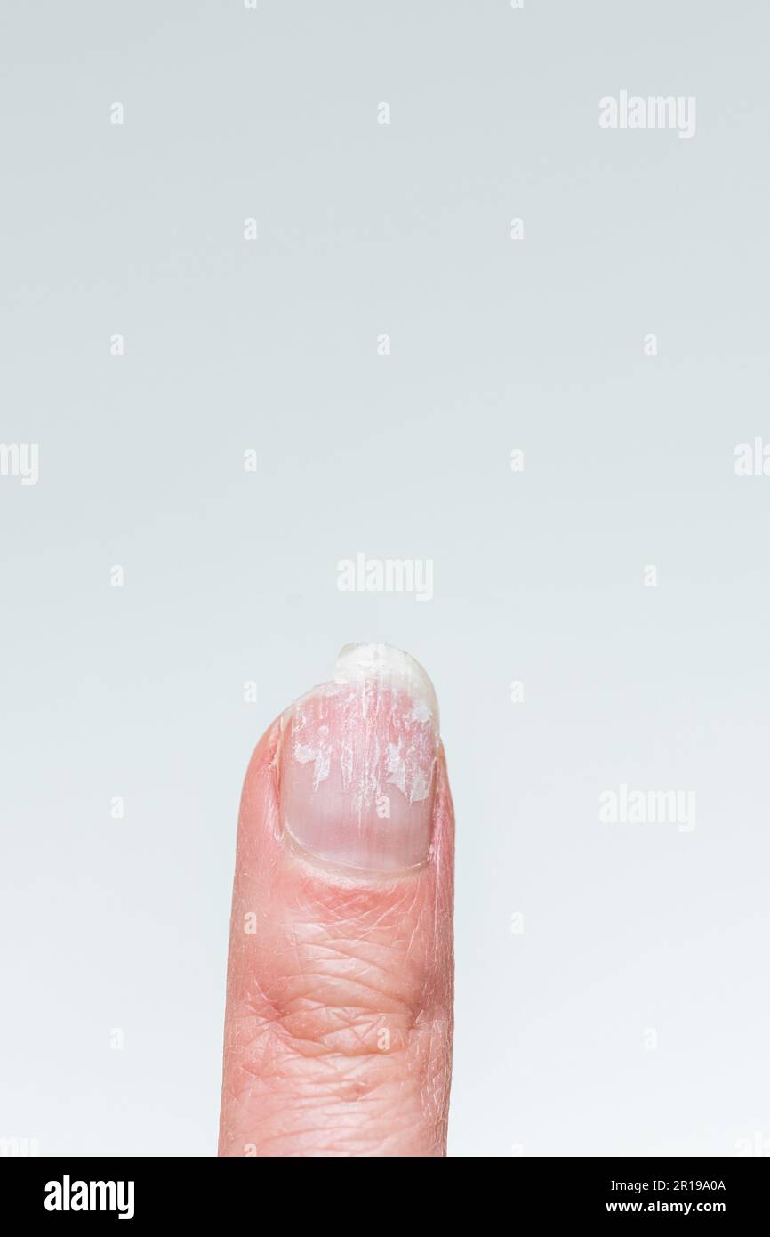 Le doigt d'une femme avec des ongles mordus et cassés sans manucure avec une cuticule surdéveloppée et une plaque à ongles endommagée après application de vernis à gel. Cosmétique Banque D'Images