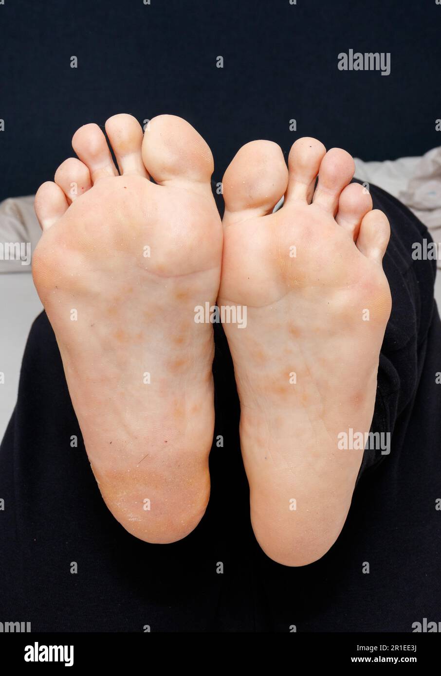 Eczéma dyshidrotique sur la semelle des pieds femelles Banque D'Images