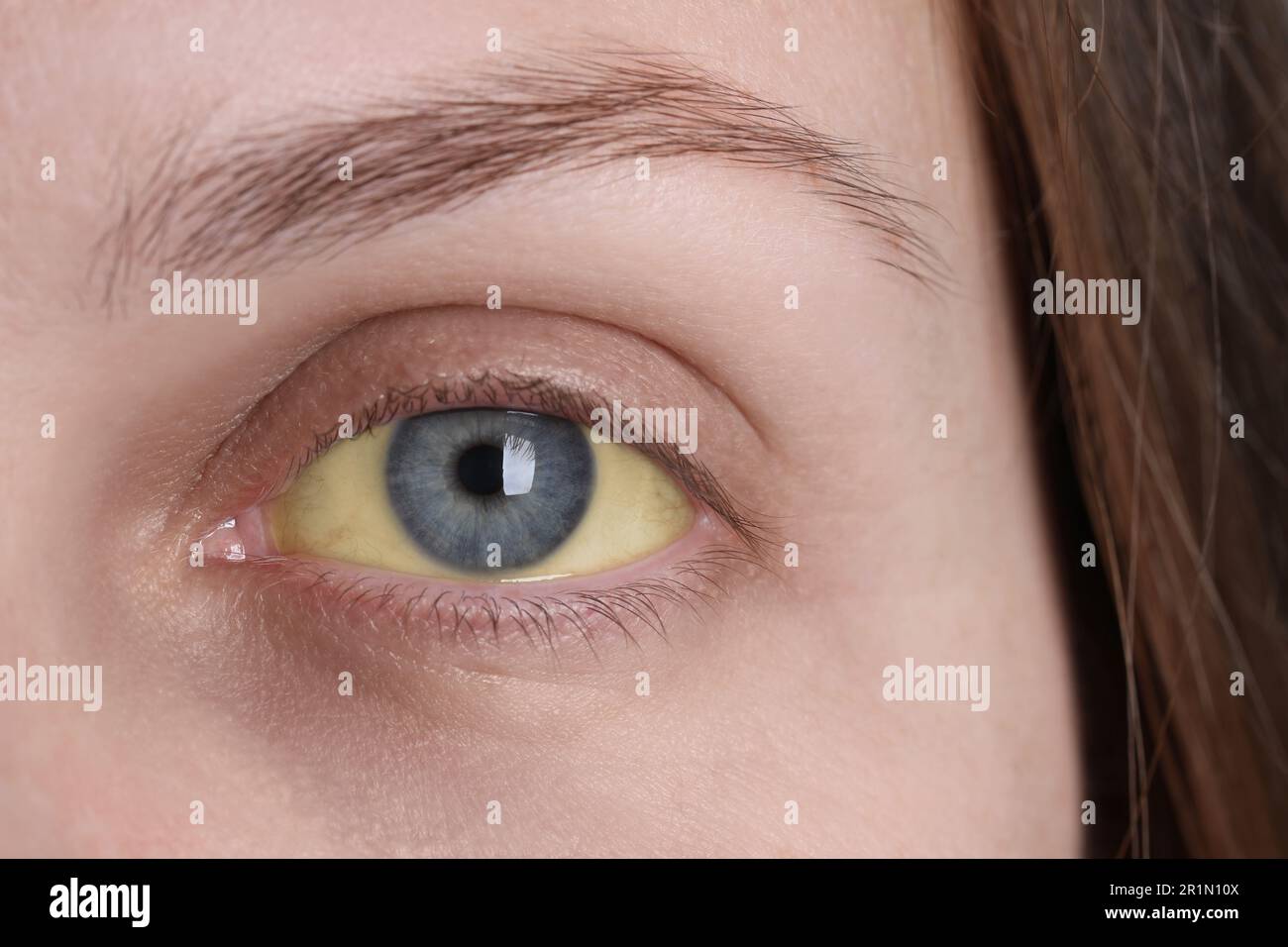 Femme aux yeux jaunes, vue rapprochée. Symptôme de l'hépatite Banque D'Images