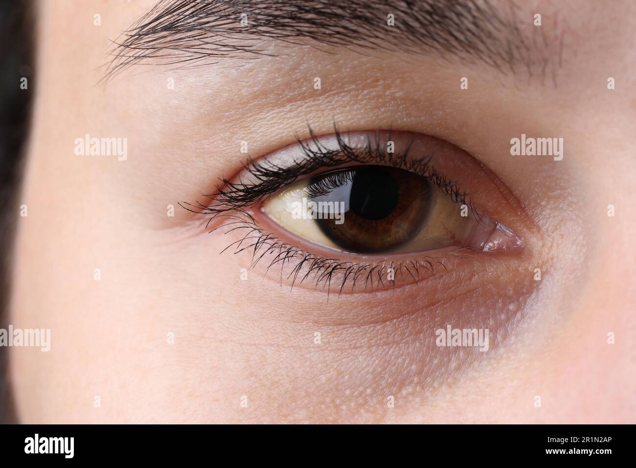 Femme aux yeux jaunes, gros plan. Symptôme de l'hépatite Banque D'Images
