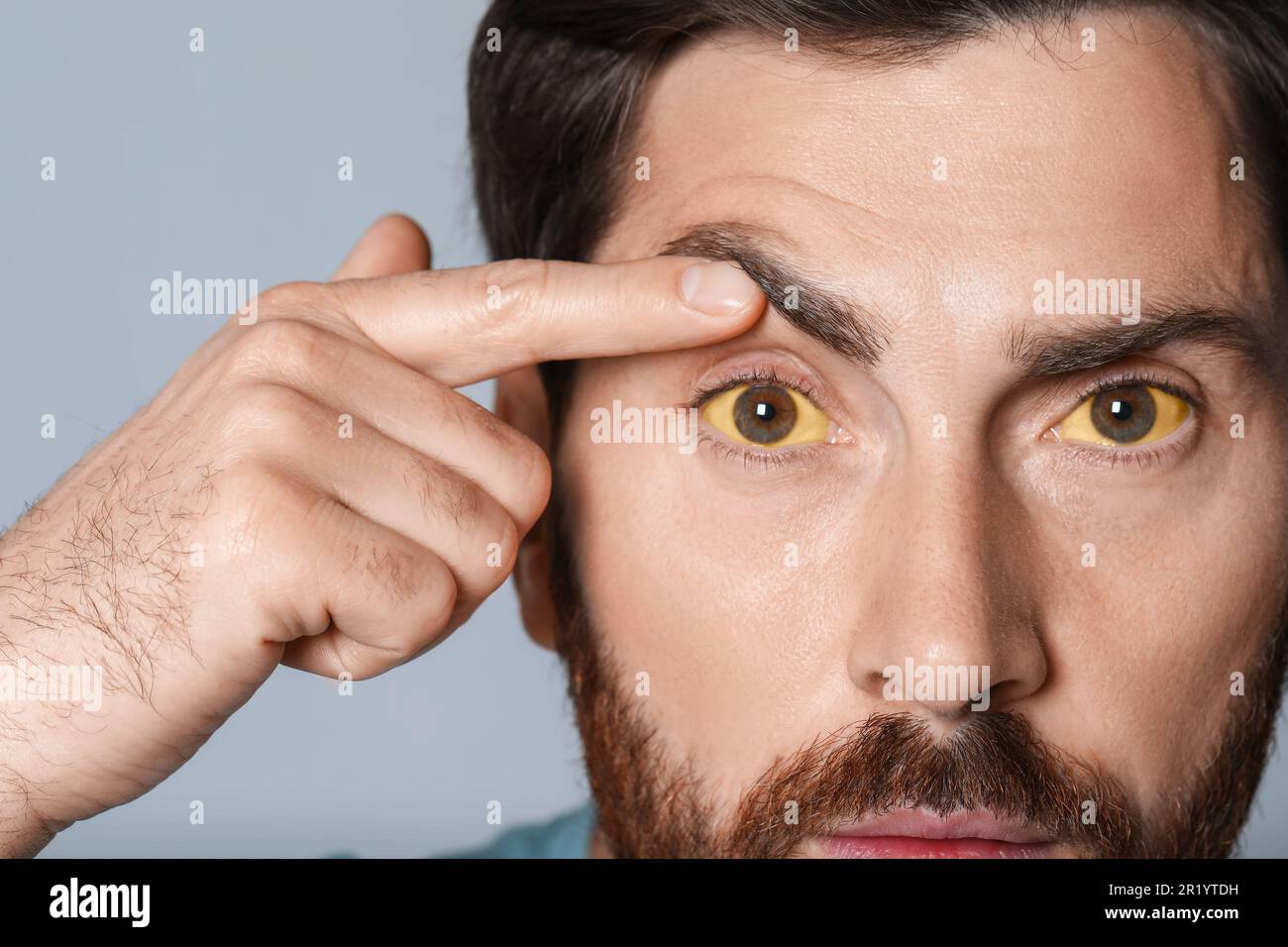 Homme avec des yeux jaunes sur fond gris, gros plan. Symptôme de l'hépatite Banque D'Images