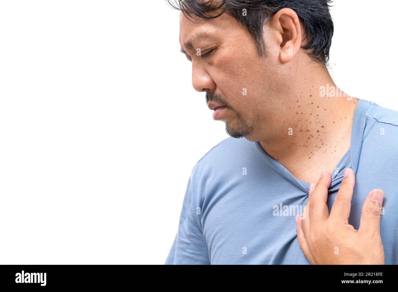 homme âgé d'âge moyen avec des étiquettes de peau ou de l'acrochordon sur son cou isolé sur fond blanc. Concept de soins de santé Banque D'Images