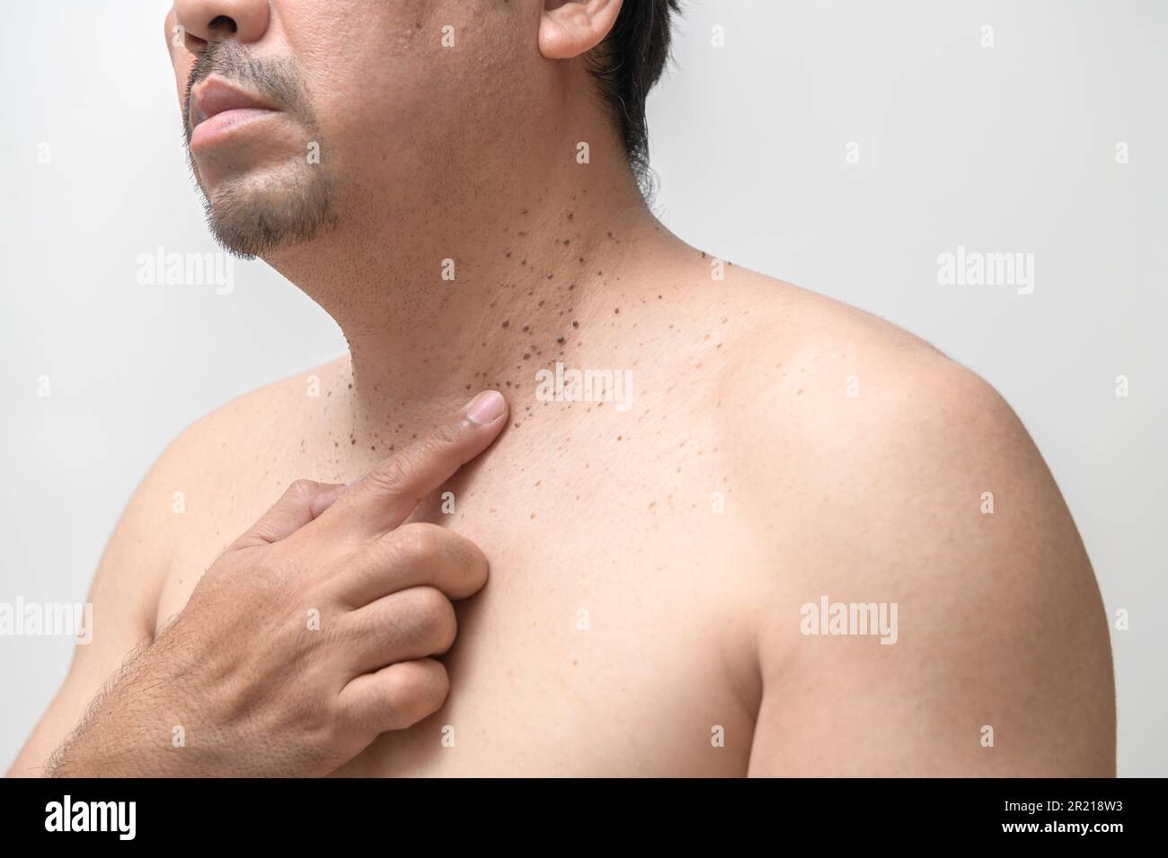 l'homme âgé d'âge moyen pointe vers des étiquettes de peau ou d'acrochordon sur son cou isolé sur fond blanc. Concept de soins de santé Banque D'Images