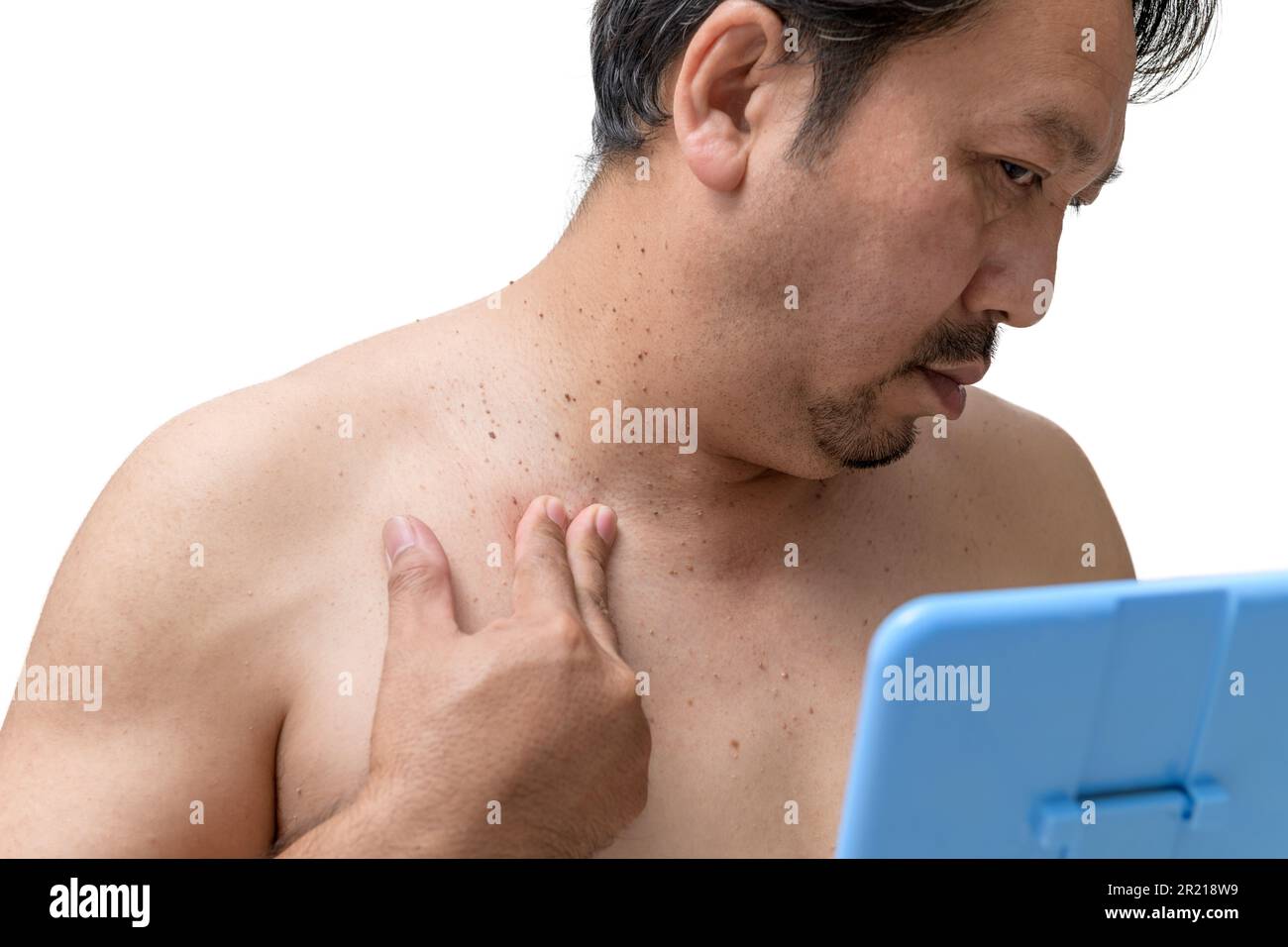 l'homme âgé d'âge moyen s'inquiète des marques de peau ou de l'acrochordon sur son cou isolé sur fond blanc. Concept de soins de santé Banque D'Images