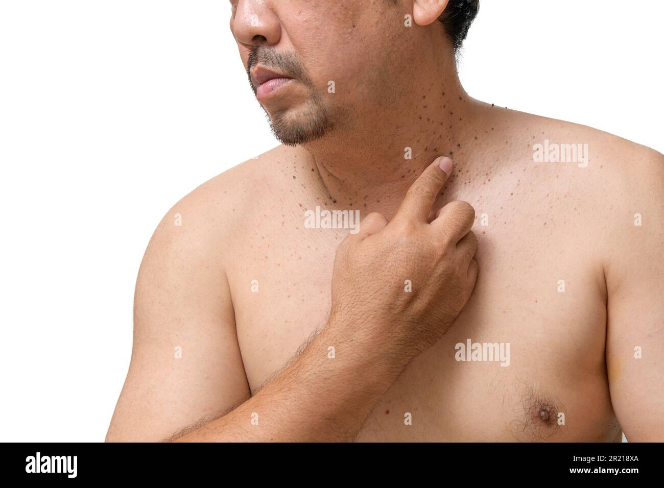 l'homme âgé d'âge moyen pointe vers des étiquettes de peau ou d'acrochordon sur son cou isolé sur fond blanc. Concept de soins de santé Banque D'Images