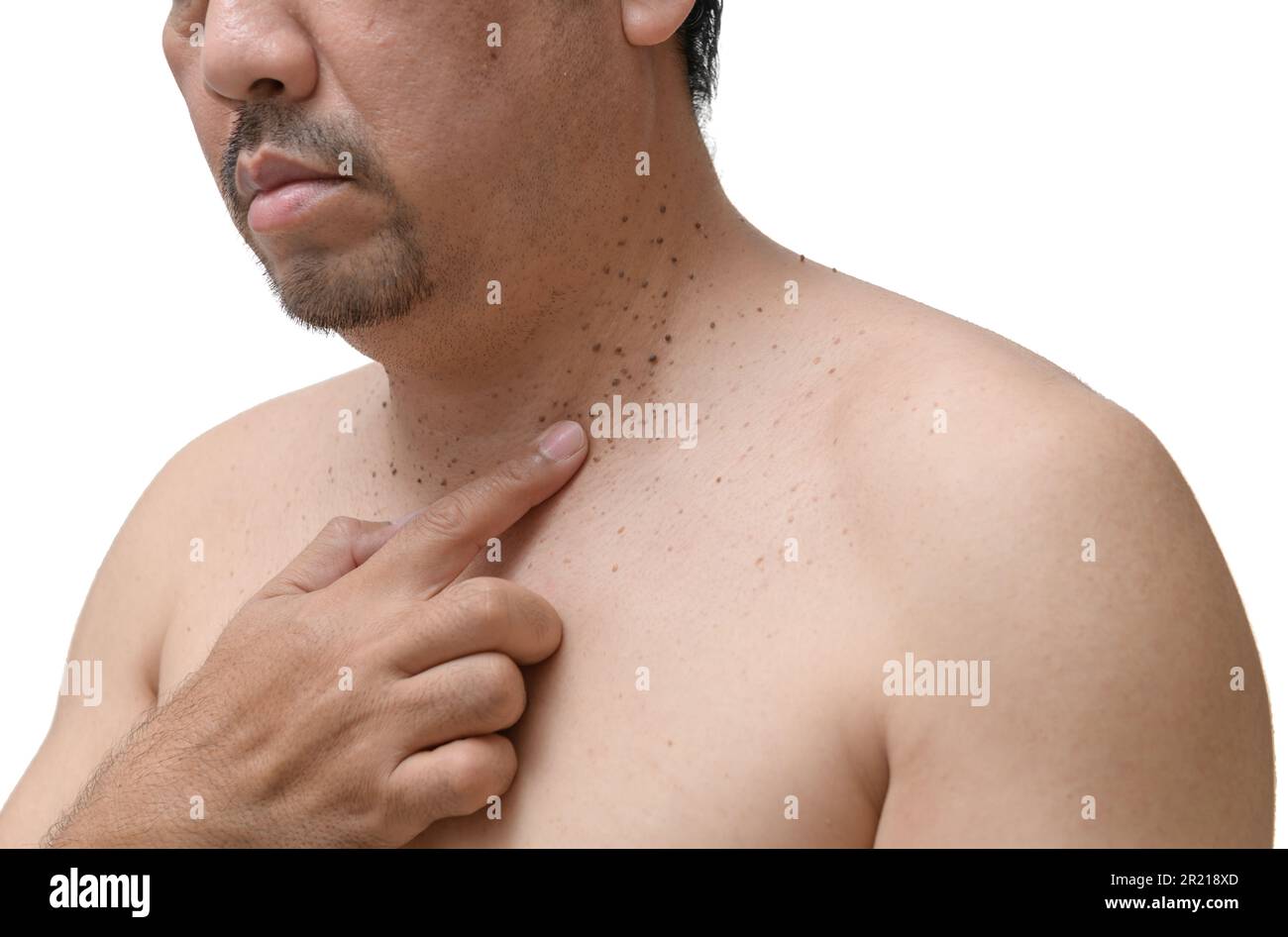 l'homme âgé d'âge moyen pointe vers des étiquettes de peau ou d'acrochordon sur son cou isolé sur fond blanc. Concept de soins de santé Banque D'Images