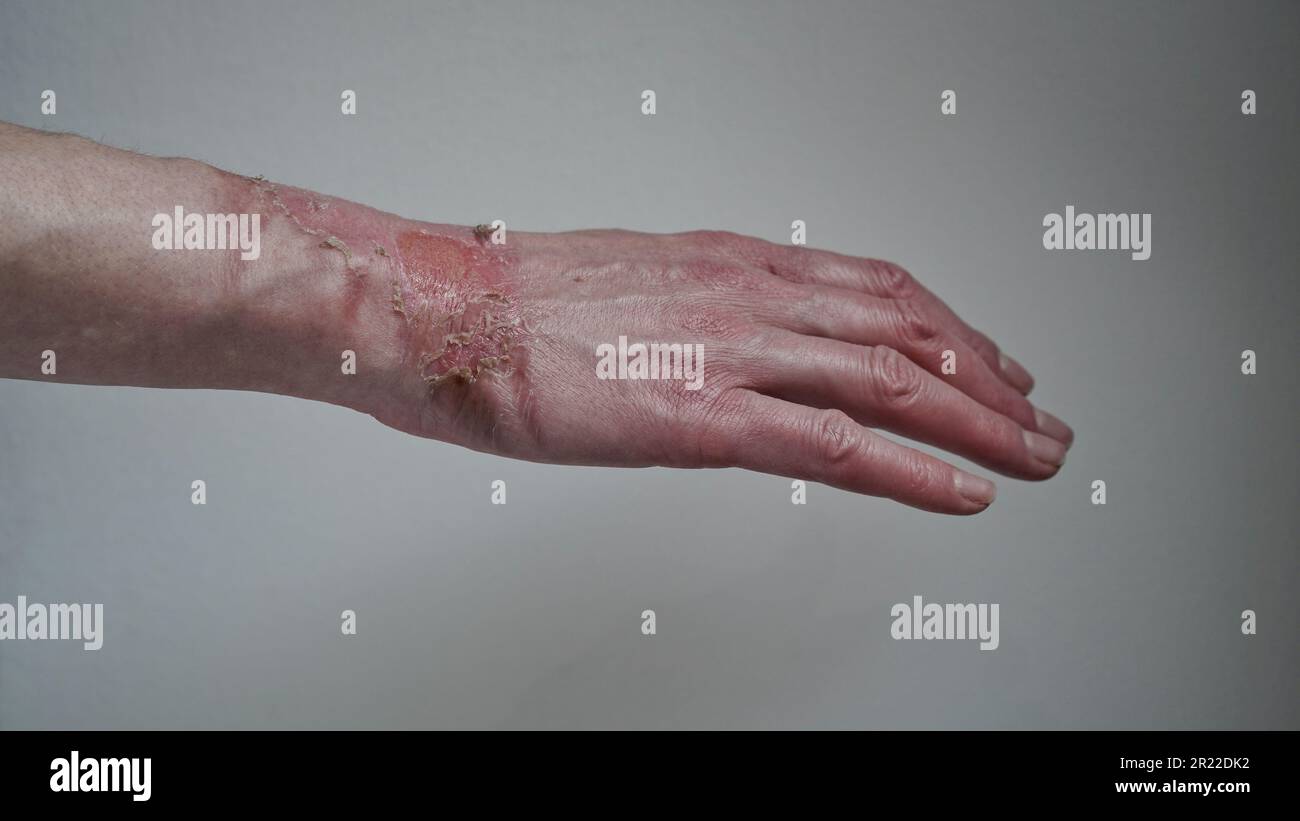 Brûlure au 1er degré Banque de photographies et d’images à haute résolution Alamy