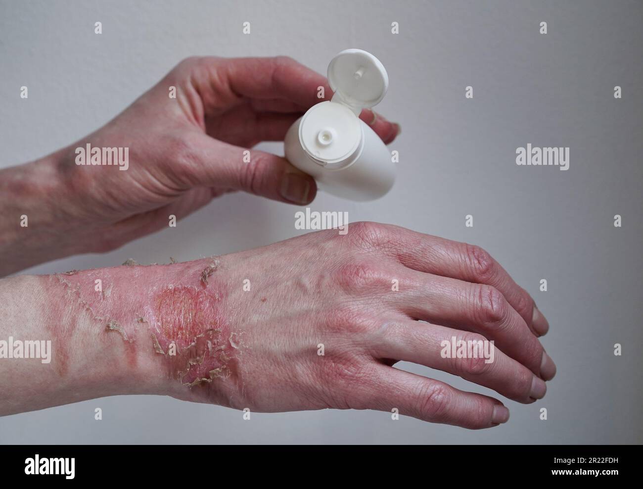 Brûlure au 1er degré Banque de photographies et d’images à haute résolution Alamy