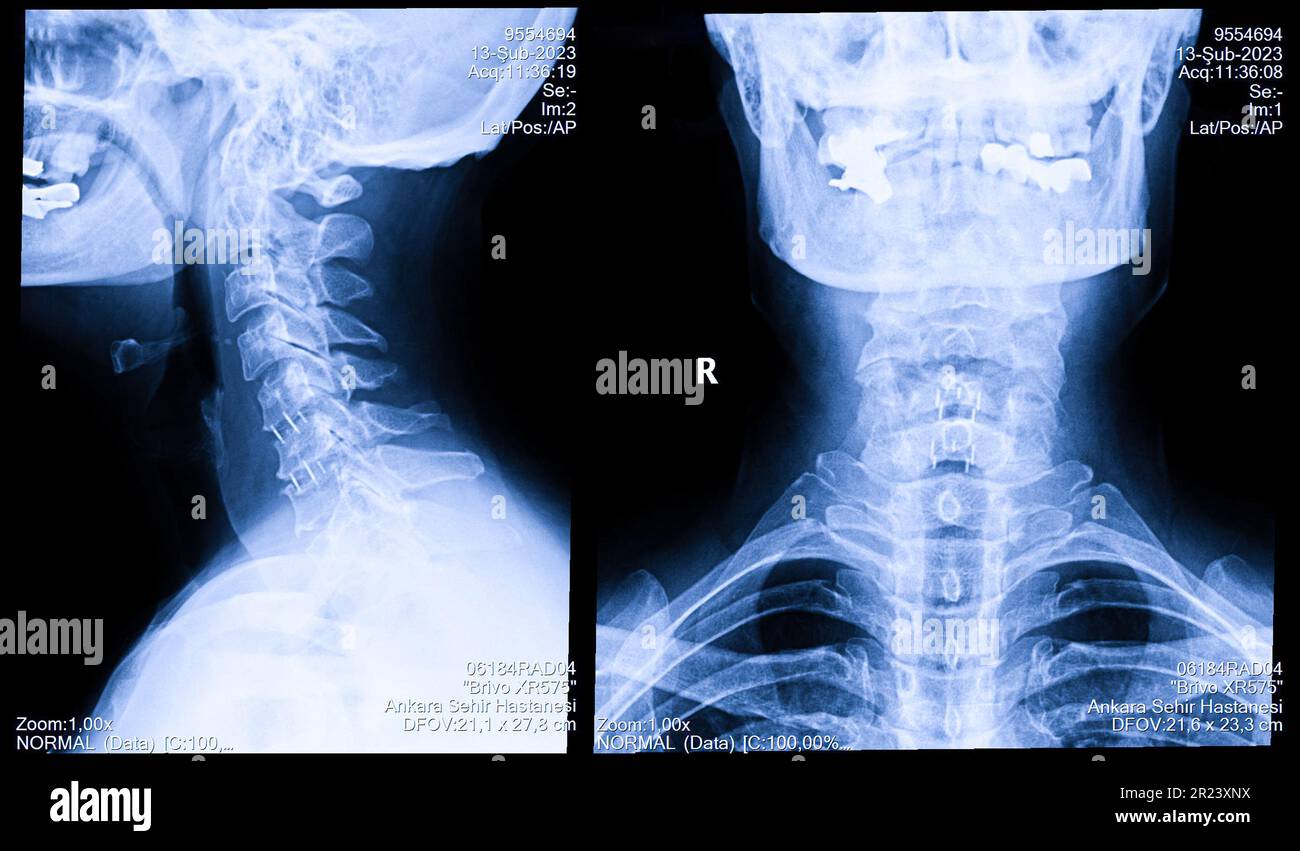 Radiographie du rachis cervical chez la femme, radiographie du cou Banque D'Images