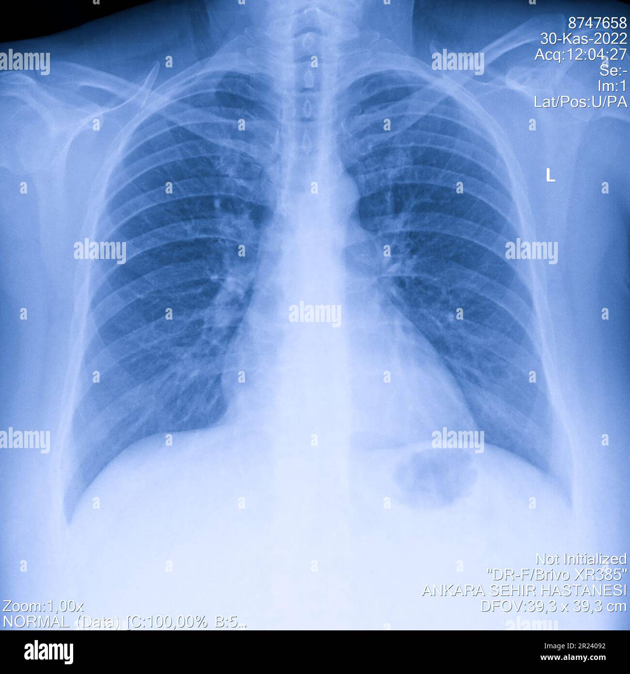 Radiographie du thorax humain pour l'examen des poumons, PA vers le haut à droite. Poumons infectés par le cancer. Dépistage de virus Banque D'Images