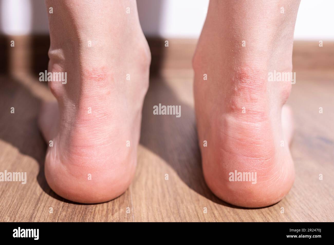 Gros plan dermatite de contact allergique au pied, à la cheville ...
