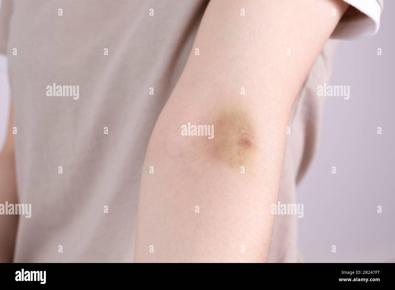 Gros plan main de la femme avec hématome, ecchymoses après injection, prélèvement sanguin sur fond gris. Blessure, phlébite post-injection. Horizontale Banque D'Images
