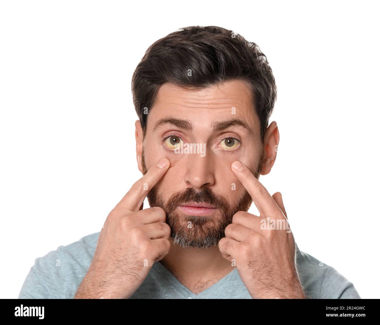 Homme avec des yeux jaunes sur fond blanc. Symptôme de l'hépatite Banque D'Images