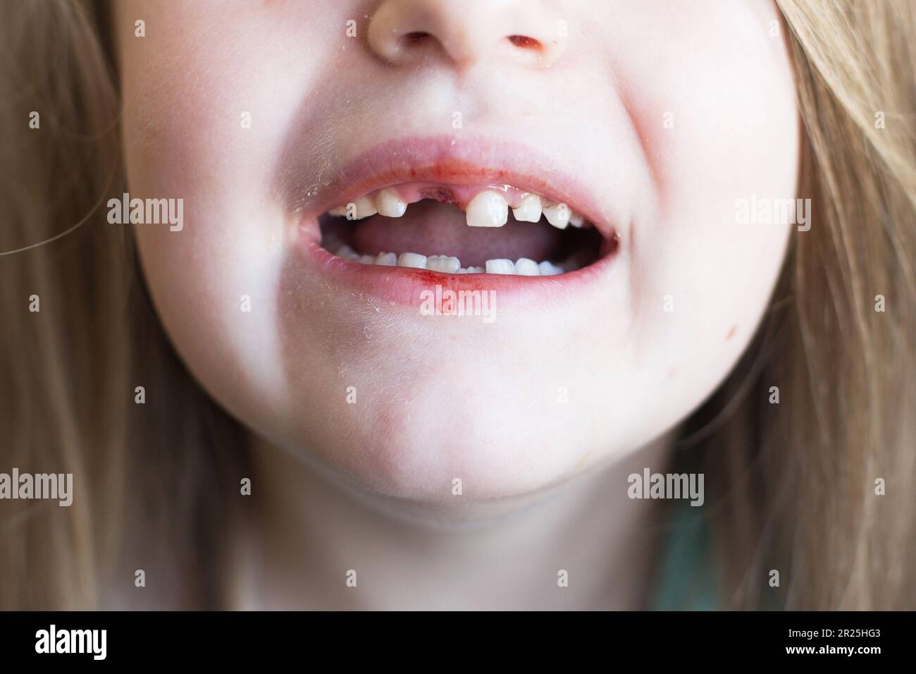 Une petite fille mignonne a perdu sa dent de lait avant de bébé. Enfant avec une plaie fraîche après avoir sorti la dent de lait.le concept de l'hygiène buccale chez les enfants. Fermer- Banque D'Images