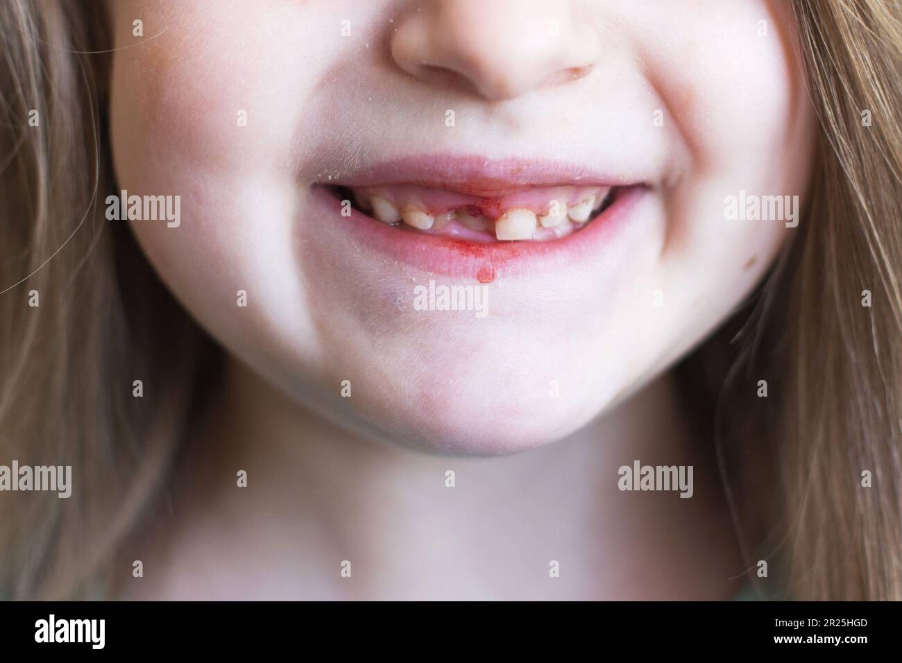 Une petite fille mignonne a perdu sa dent de lait avant de bébé. Enfant avec une plaie fraîche après avoir sorti la dent de lait.le concept de l'hygiène buccale chez les enfants. Fermer- Banque D'Images