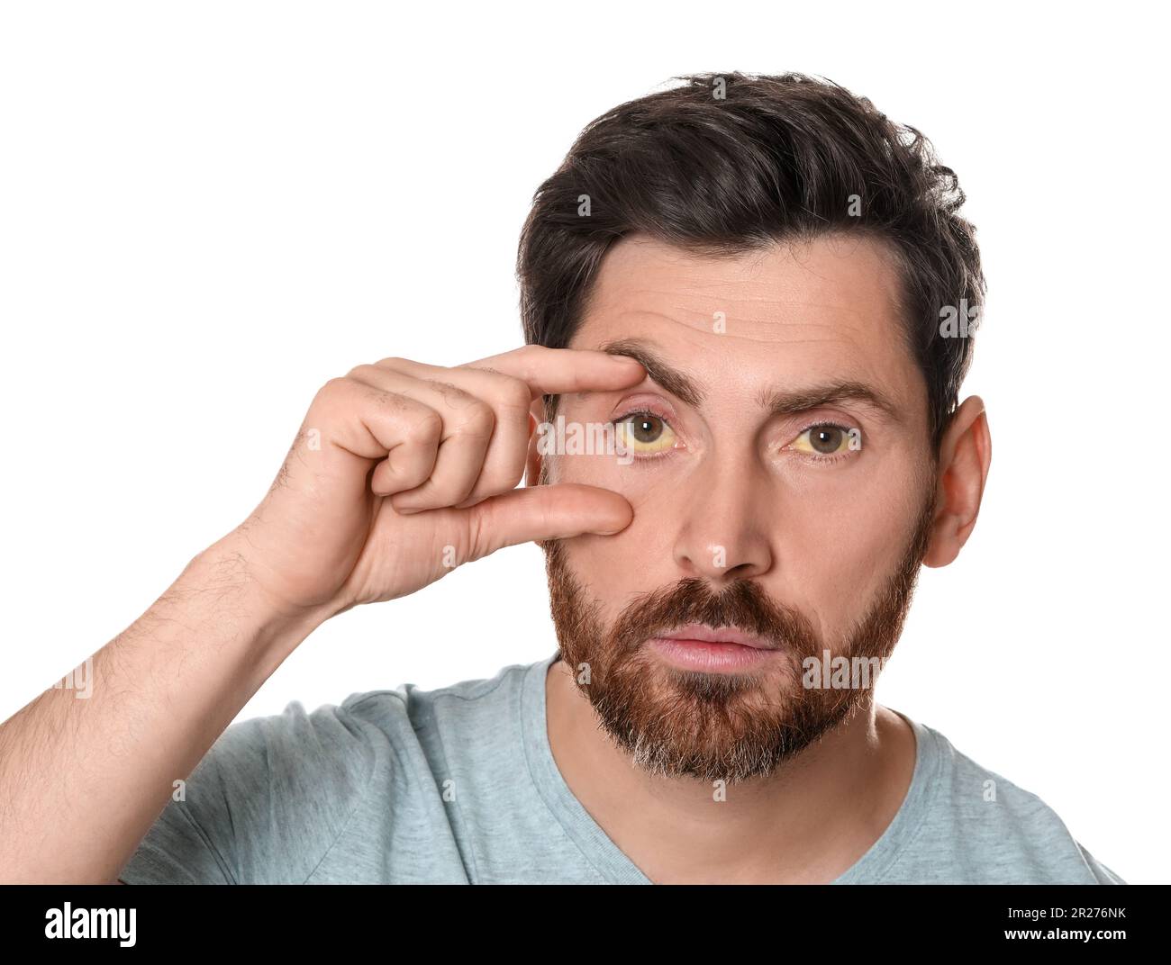 Homme avec des yeux jaunes sur fond blanc. Symptôme de l'hépatite Banque D'Images