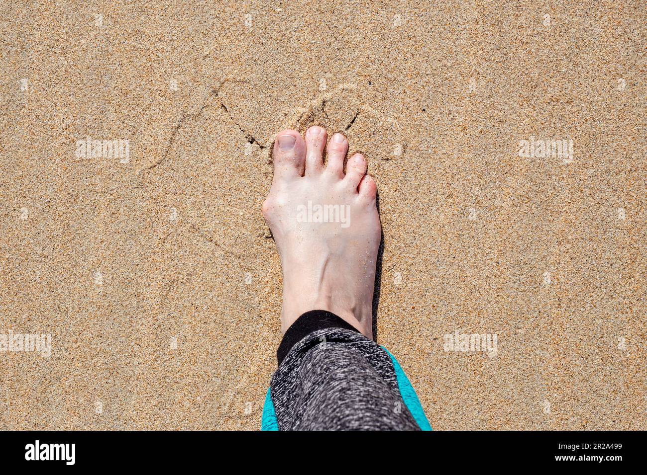 Jambe femelle avec une articulation douloureuse élargie sur le gros orteil sur du sable jaune. Banque D'Images