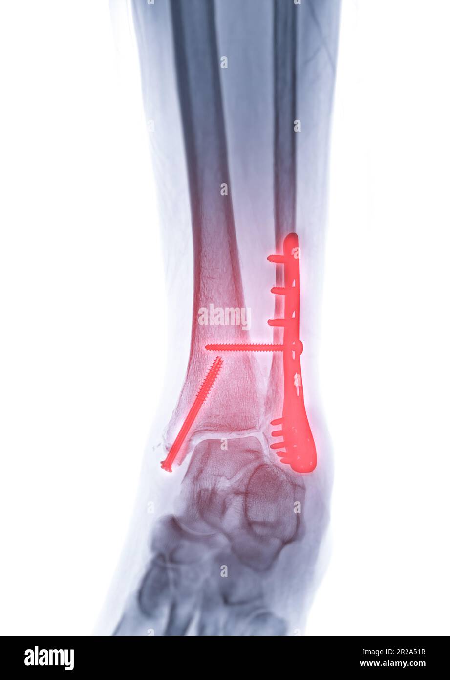 Image radiographique de l'articulation de la cheville montrant la fixation interne avec la plaque et la vis. Banque D'Images